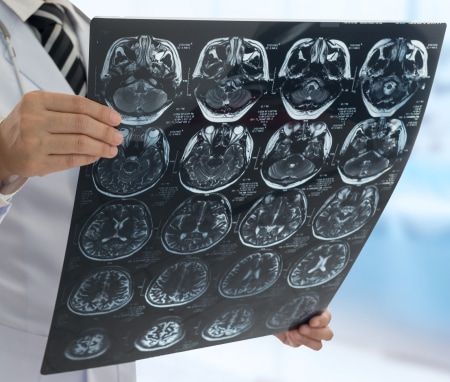 Brain Injuries